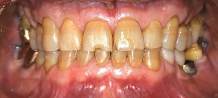 Close-up of teeth with severe discoloration and plaque buildup, showing gums and front teeth.