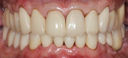 Close-up of straight, white teeth with a visible bite and pink gums