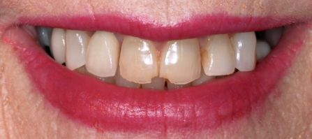 Close-up of a smiling mouth with white teeth and pink lipstick