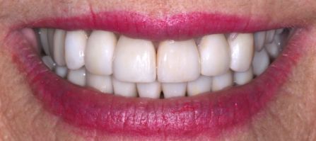 Close-up of a smiling mouth with white teeth and pink lipstick