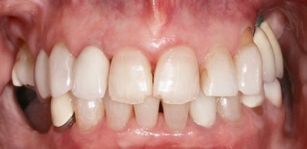 Close-up of teeth and gums with mild redness along the upper gum line