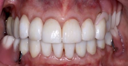 Close-up of a smiling mouth with white teeth and pink gums