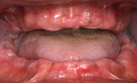 Close-up of an open mouth showing the tongue and inner lips with pink-red tissue changes.