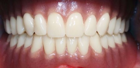 Close-up of a person’s teeth in a smile, showing white upper and lower teeth and pink gums