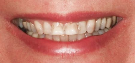 Close-up of a smiling mouth with white teeth and a dark tooth visible on the left side