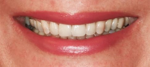 Close-up of a smiling mouth with white teeth and pink lipstick