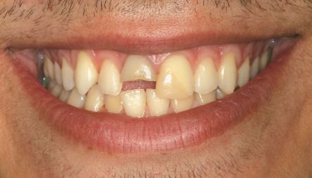 Close-up of a smiling mouth with slightly yellowed teeth and facial hair around the lips