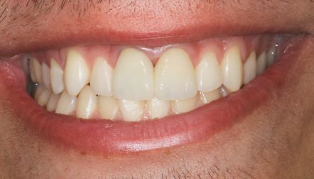 Close-up of a smiling mouth showing white teeth and pink lips