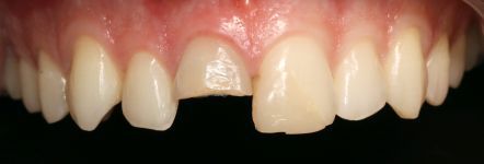 Close-up of upper front teeth with a noticeable gap and chipped tooth, showing pink gums