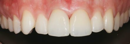 Close-up of teeth and gums, showing front upper and lower teeth