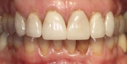 Close-up of upper and lower front teeth with noticeable yellowing and gum recession