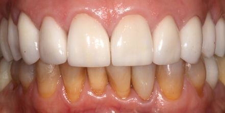 Close-up of teeth with bright white upper teeth and yellow staining on the lower gumline
