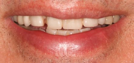 Close-up of a smiling mouth showing teeth and pink lips