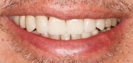 Close-up of a smiling mouth with white teeth and facial stubble
