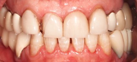 Close-up of teeth with a gap between the front incisors and pink gums visible
