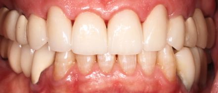 Close-up of teeth and gums with noticeable crowding and misalignment