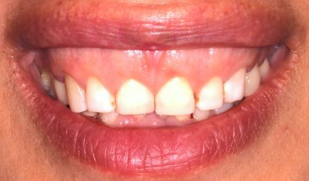 Close-up of a smiling mouth showing teeth and red lips