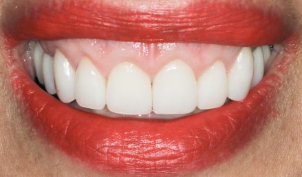 Close-up of a smiling mouth with white teeth and red lipstick