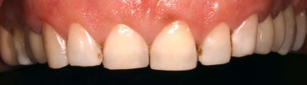 Close-up of upper front teeth and gums with small gaps between the teeth