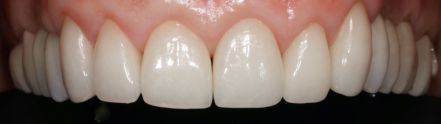 Close-up of white upper front teeth with pink gums, shown in a dental mold or smile model