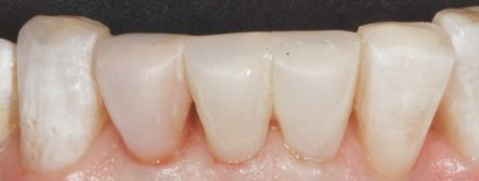 Close-up of lower front teeth and gums, showing slight redness near the gumline.