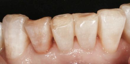 Close-up of lower front teeth with yellow-brown buildup and receding gums