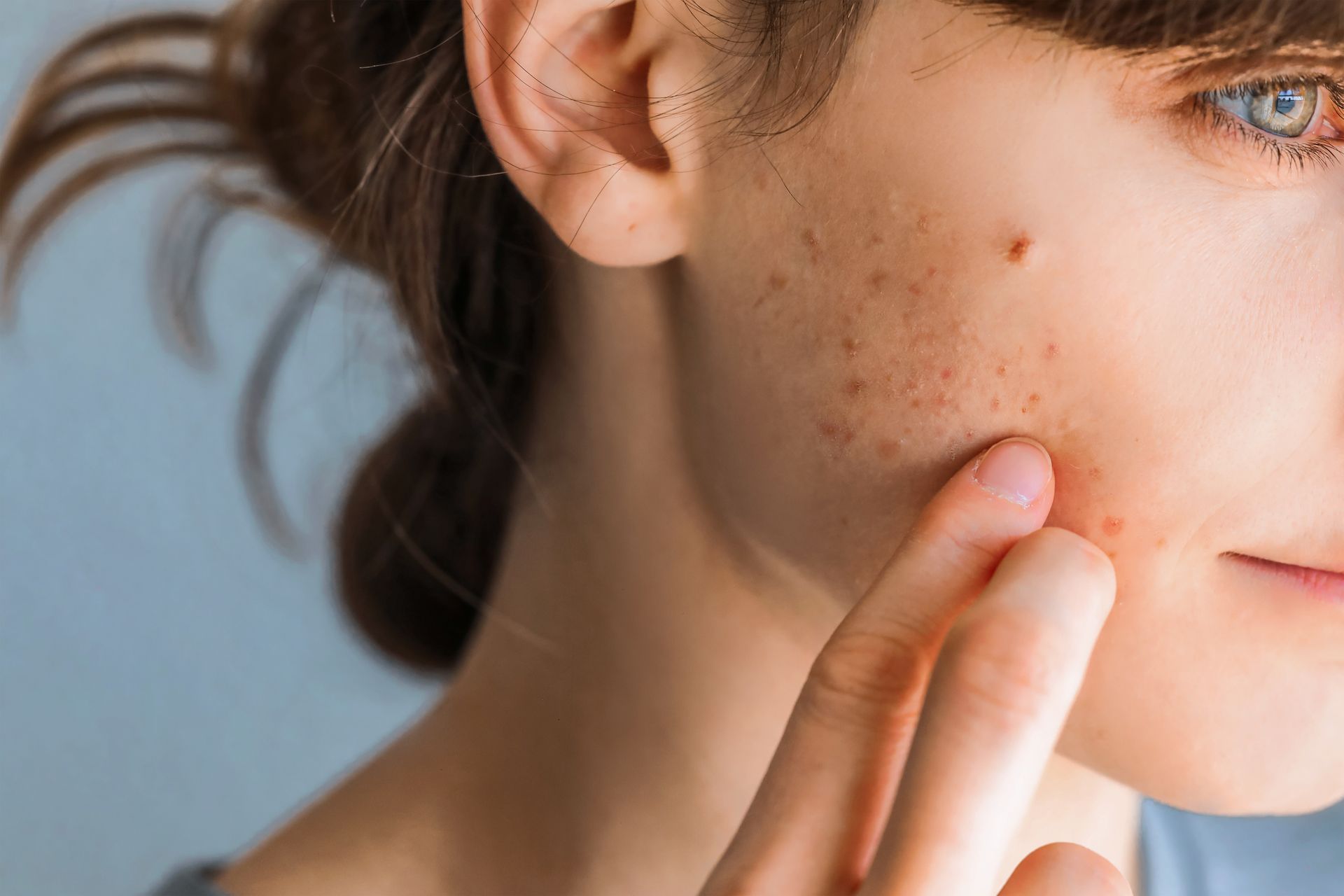 Rima-soboh-medecine-esthetique-Beauvais-acné