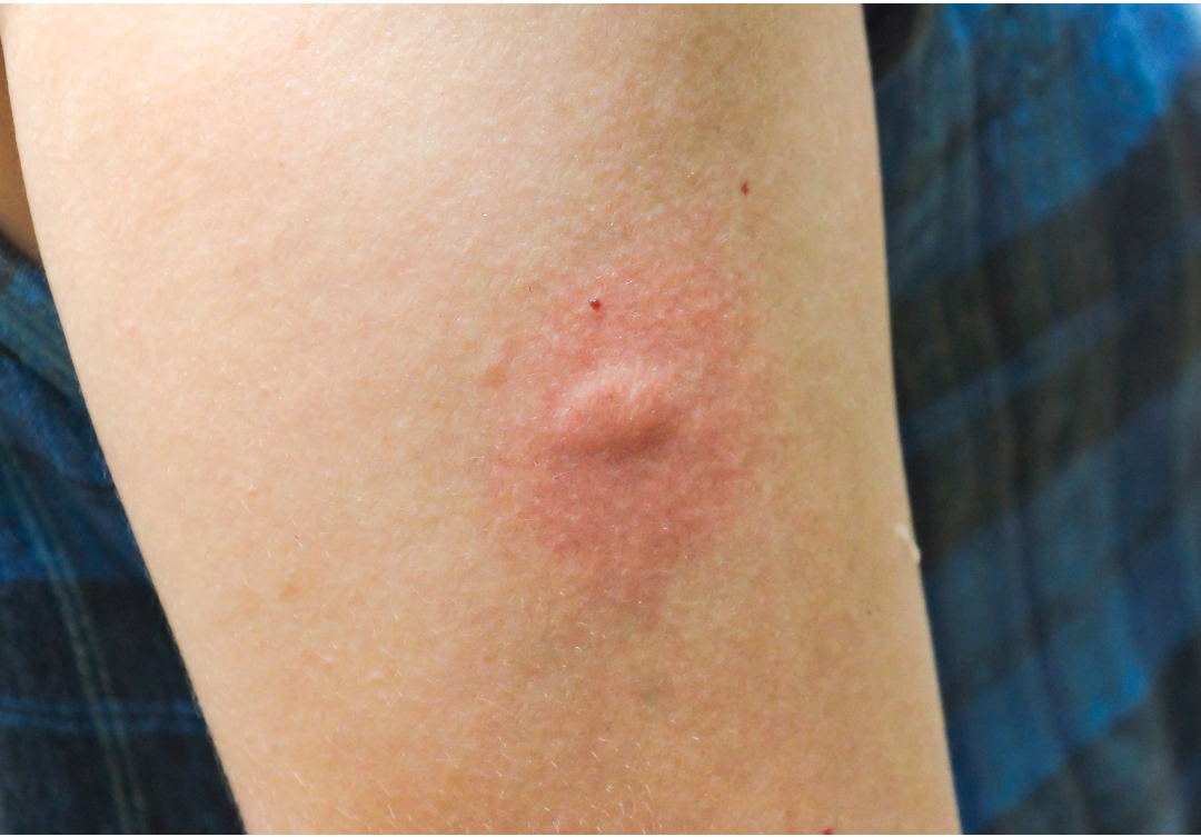 Infected Insect Bites Treatment Broadstairs Pharmacy First Infected Insect Bites Treatment Broadstairs Pharmacy First