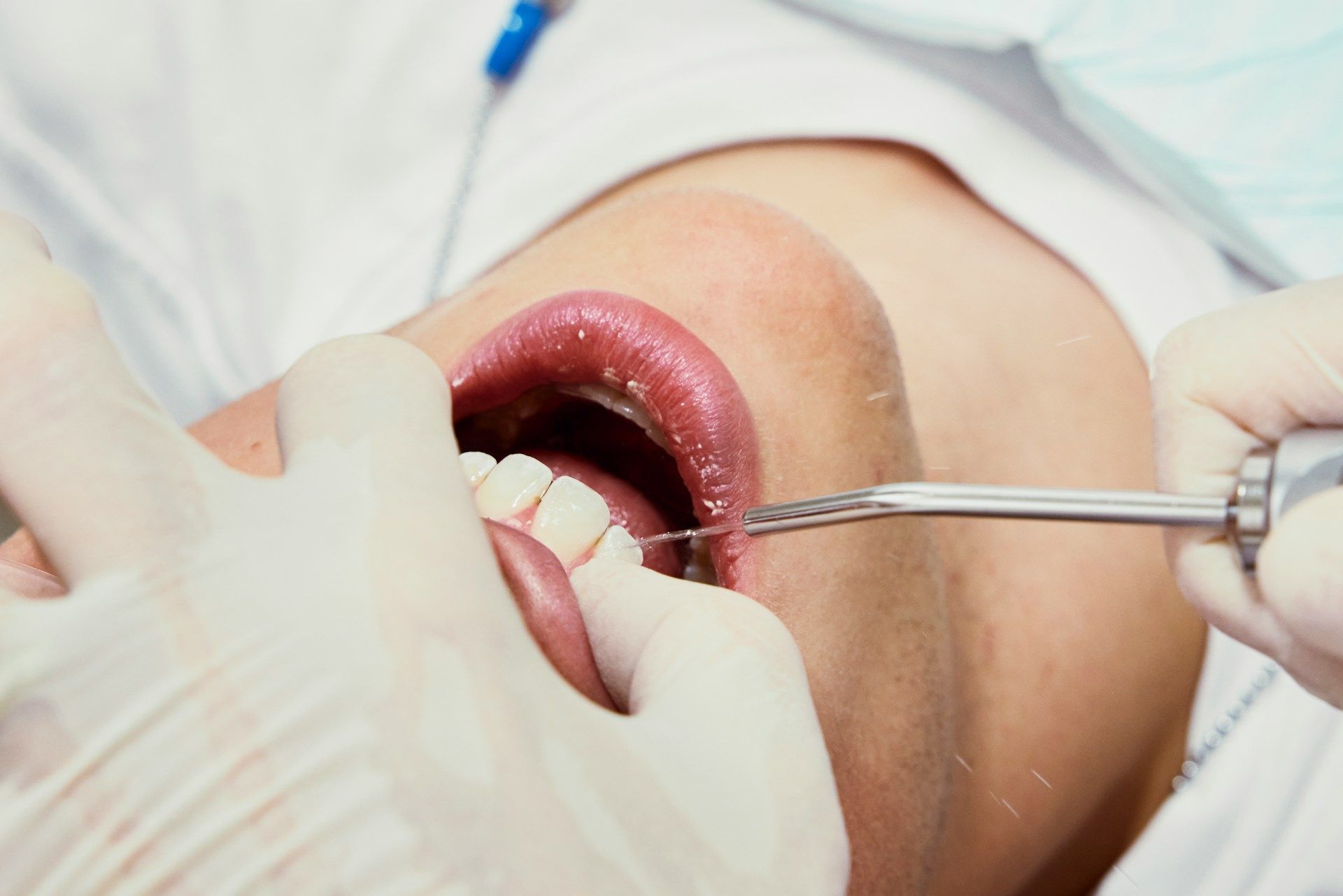 Tooth Extraction