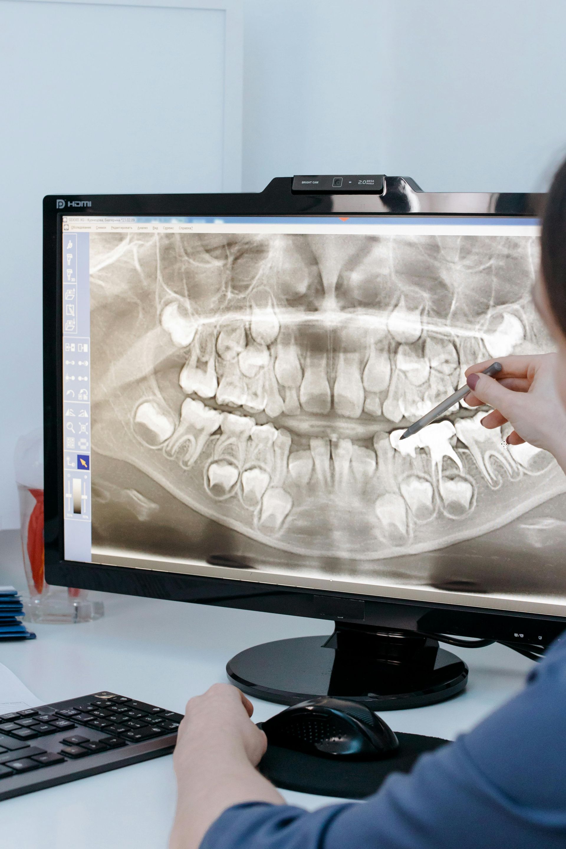 Dentist pointing to tooth on a panoramic X-ray displayed on a computer screen.
