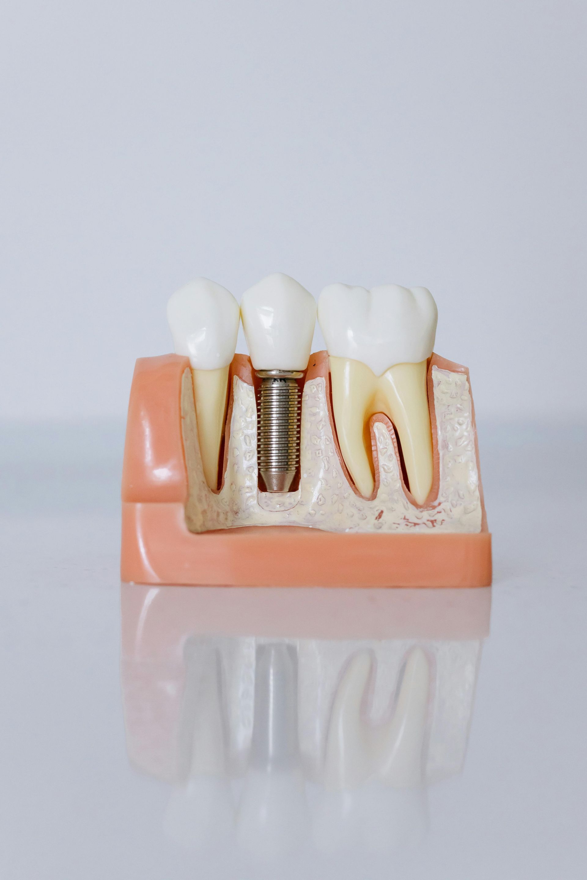 Dental model showing a tooth implant between two natural teeth in a pink gum.