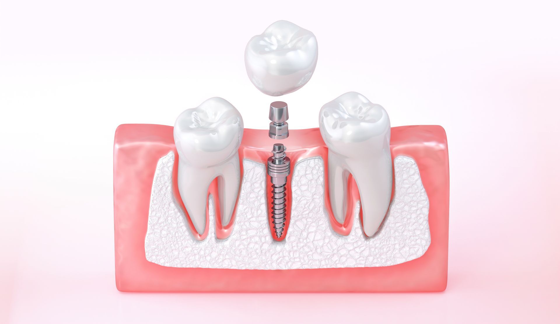 Cross-section of jaw showing tooth implant: crown, screw, and adjacent teeth, pink gums, white bone.