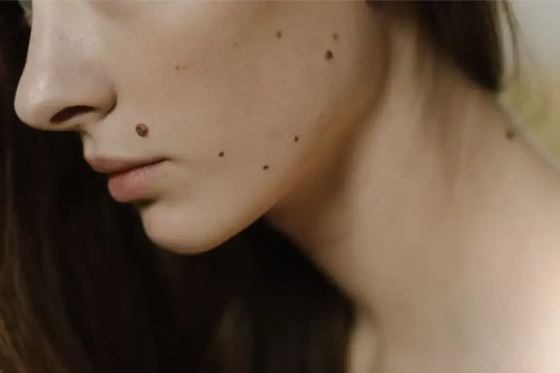 Close-up profile of a person’s face with a neutral expression and small facial moles