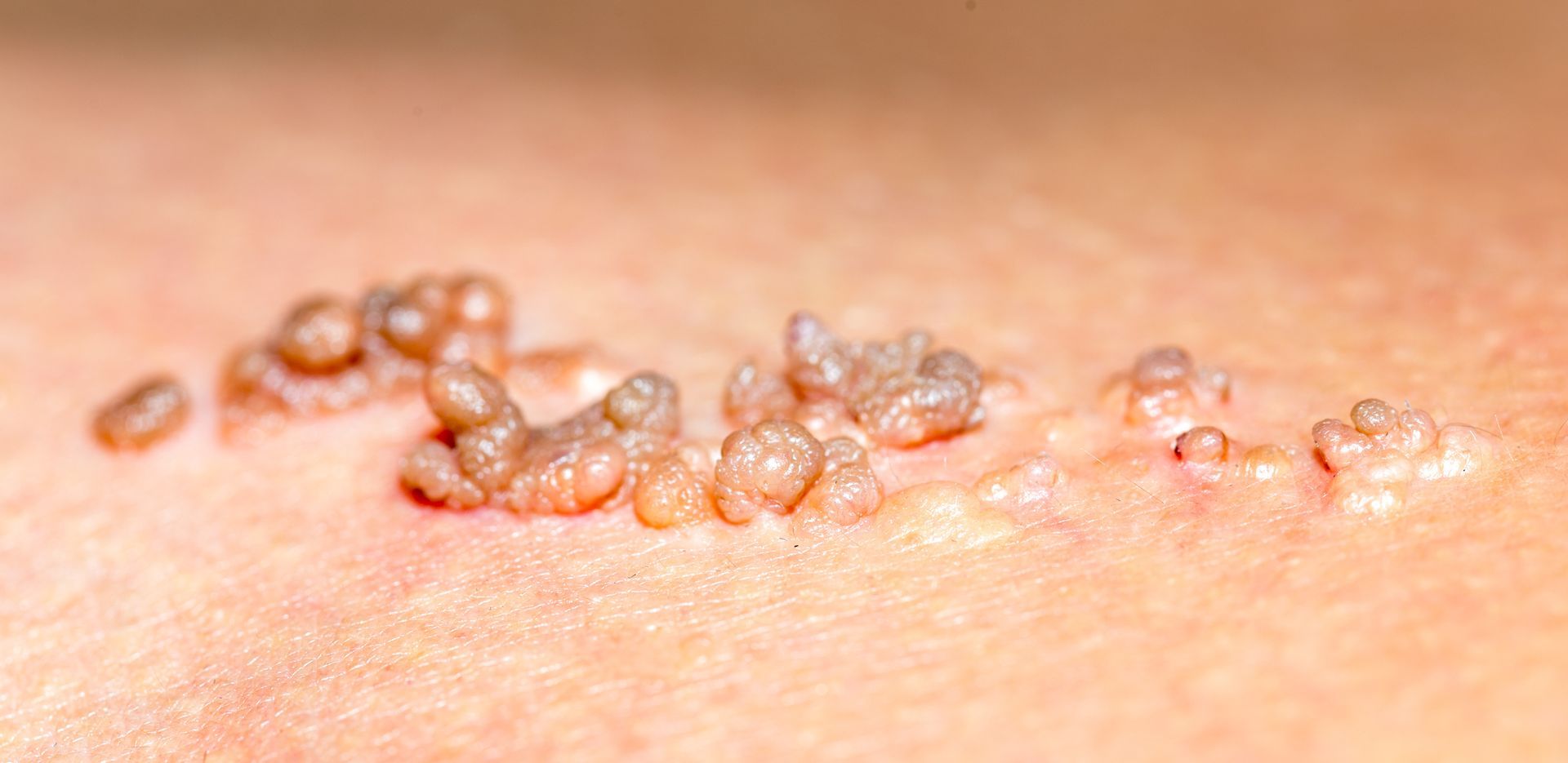 Skin Tag Removal Phoenix