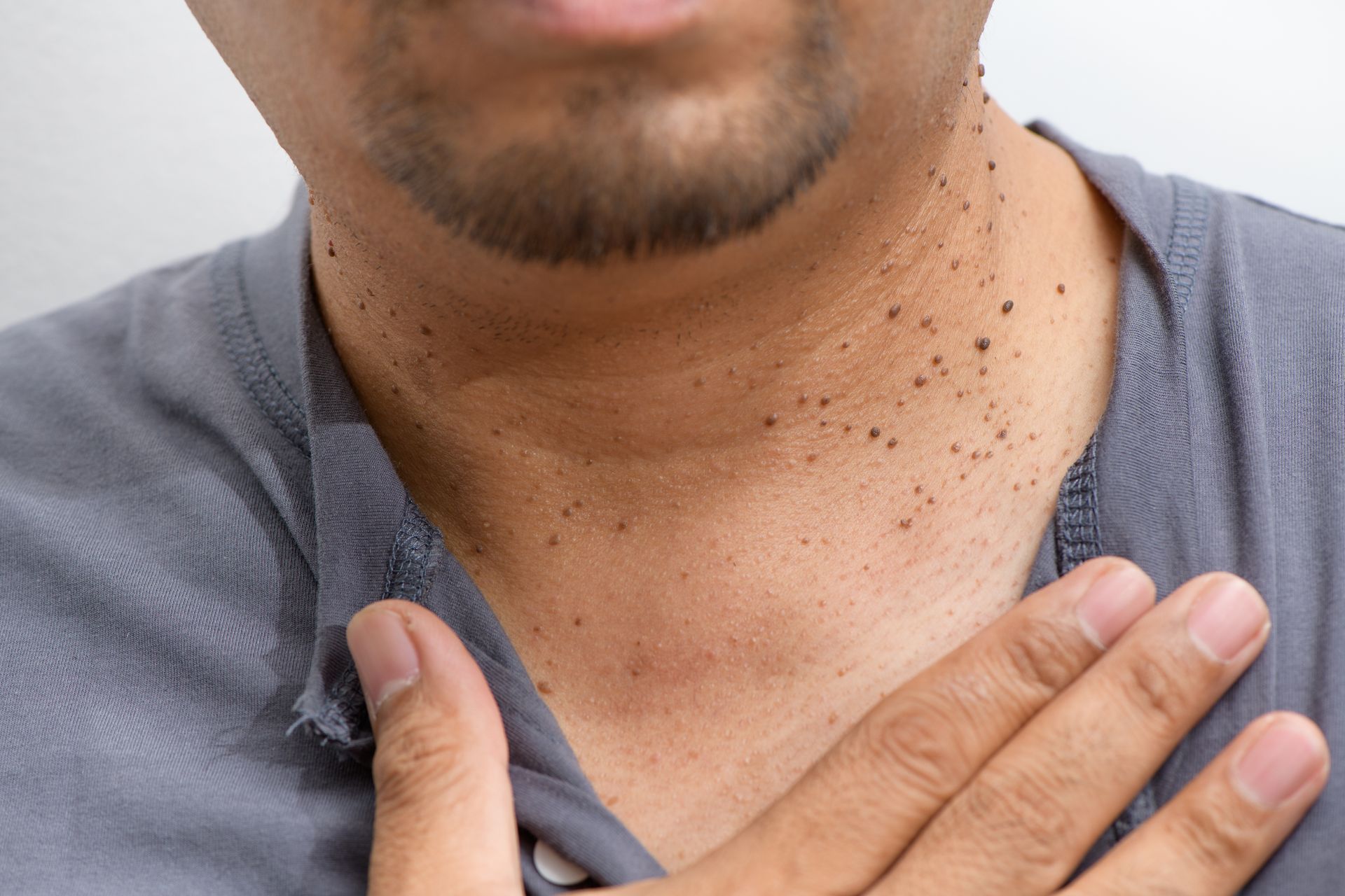 Skin Tag Removal Phoenix