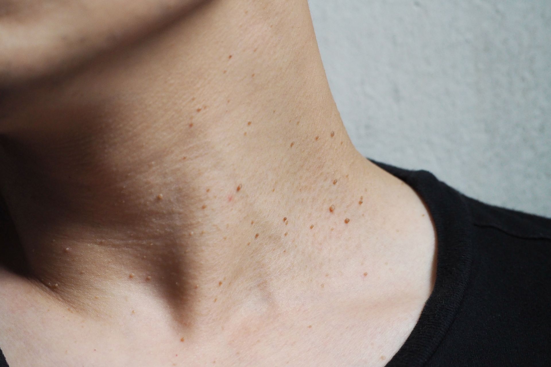 Skin Tag Removal Phoenix