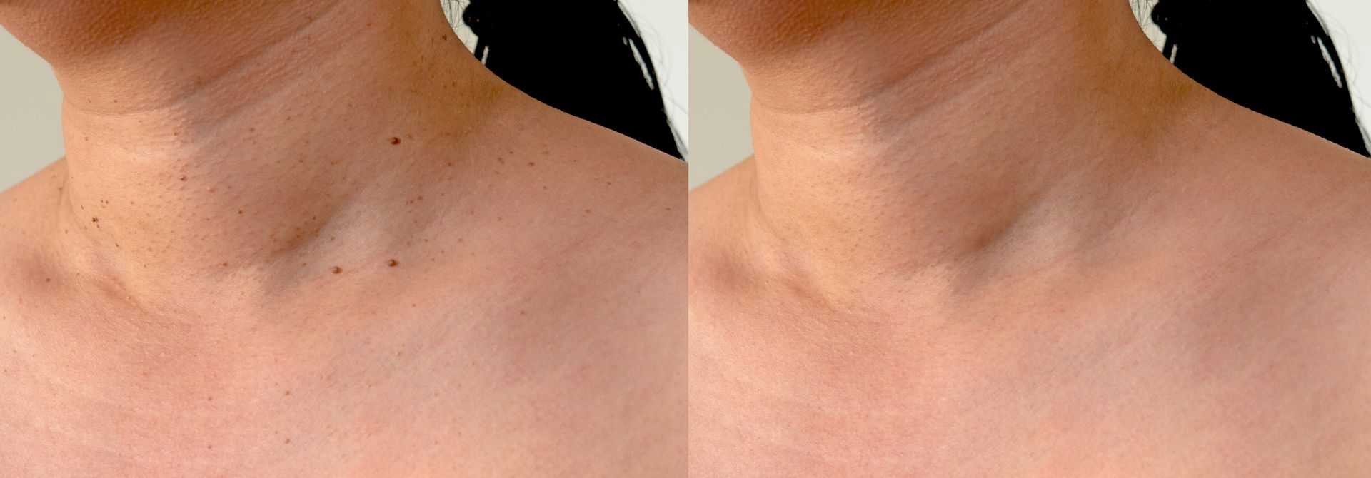 Skin Tag Removal