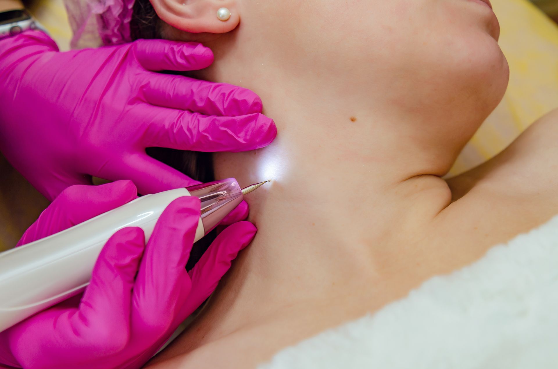 Professional Skin Tag Removal