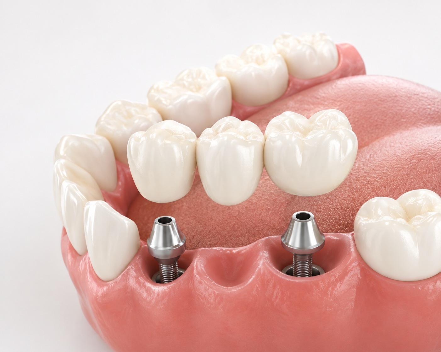 3D dental implant model with pink gums and white teeth