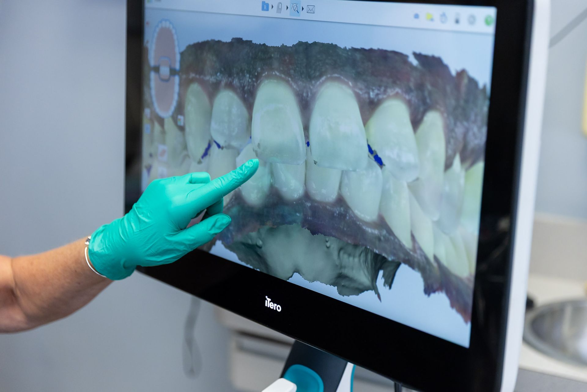 Gloved hand pointing at a dental scan displayed on a monitor