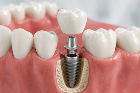 Modello di impianto dentale con un impianto metallico nella gengiva tra i denti bianchi