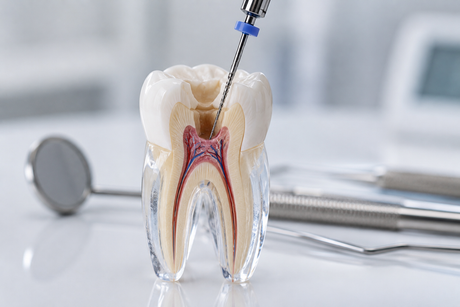 Modello dentale di un dente con trapano e strumenti odontoiatrici sullo sfondo.