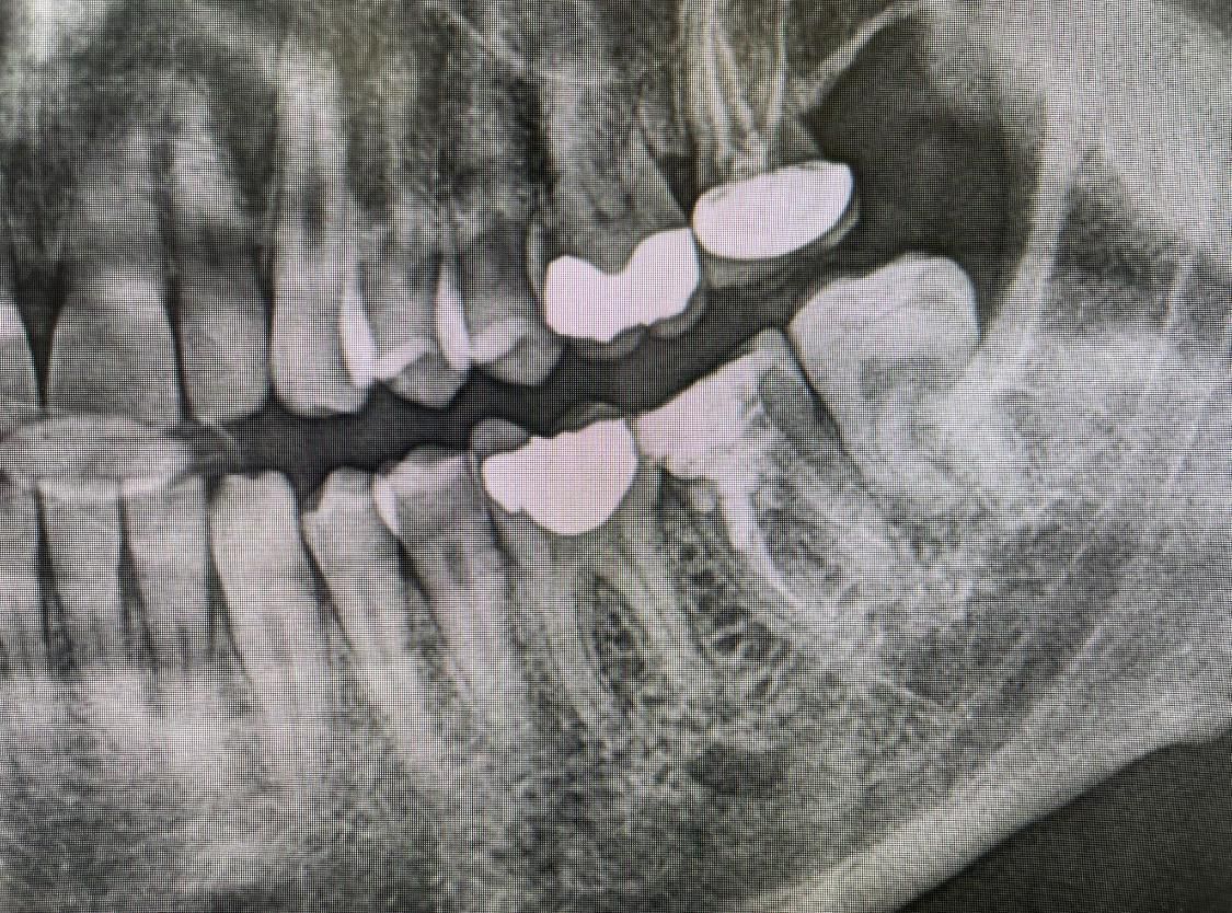 Primo piano di una radiografia dentale in scala di grigi che mostra denti e mandibola, con i denti evidenziati nella parte centrale della bocca.