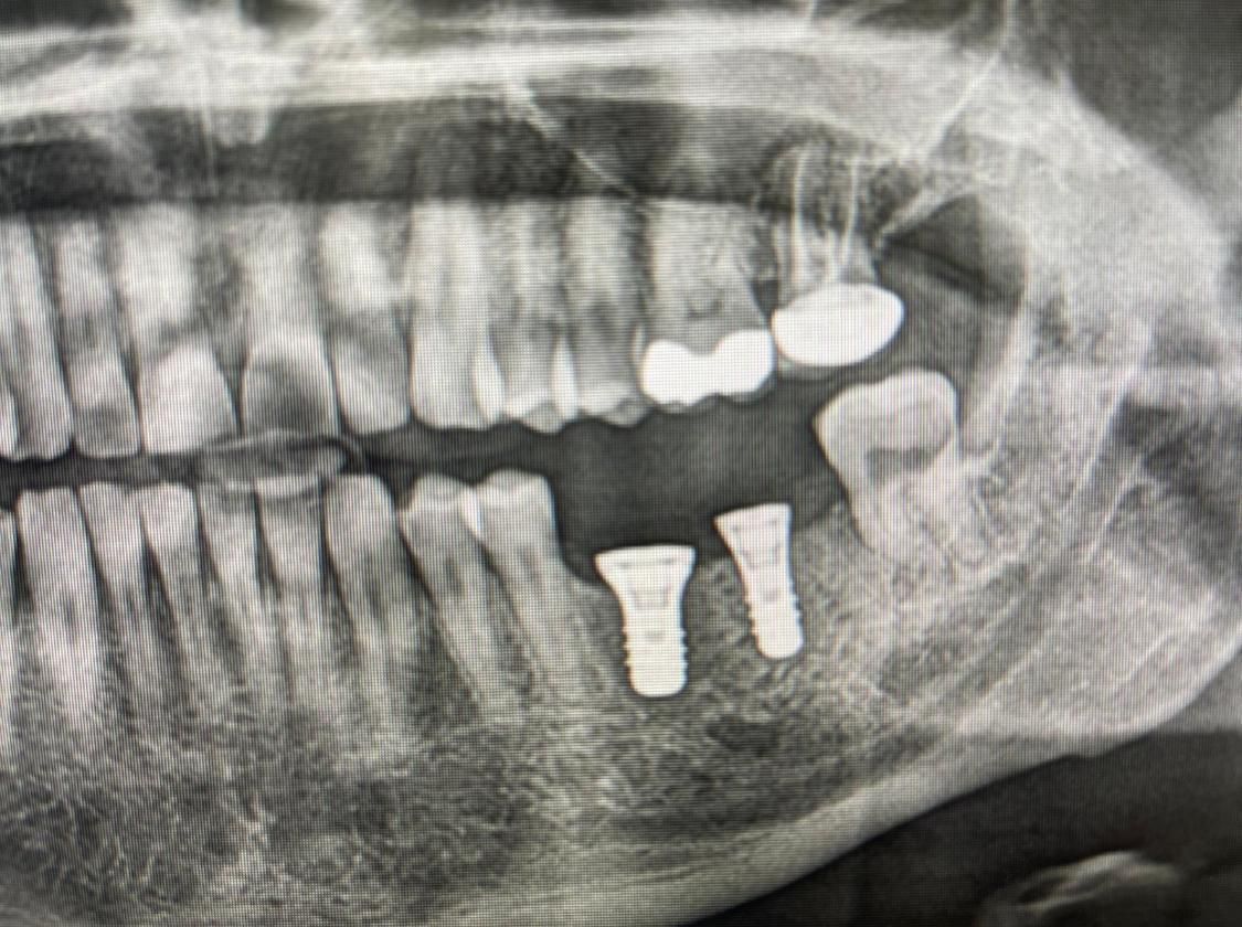 Radiografia dentale che mostra denti, corone e due impianti nella mascella inferiore.