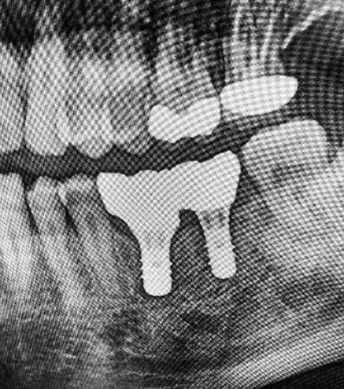 Radiografia dentale che mostra i molari inferiori con due impianti e i denti superiori con otturazioni.