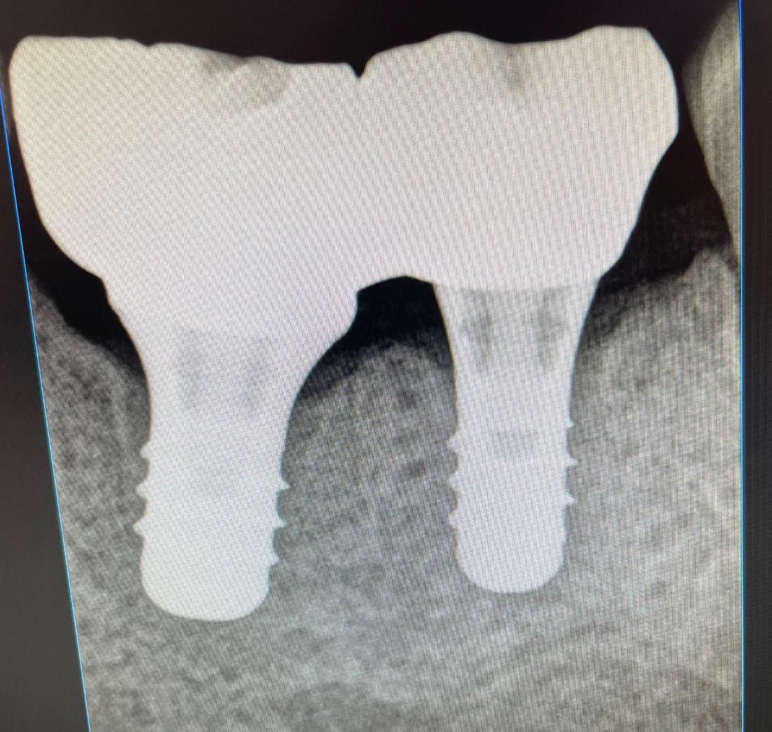 Radiografia di due impianti dentali che sostengono un ponte superiore nell'osso mascellare
