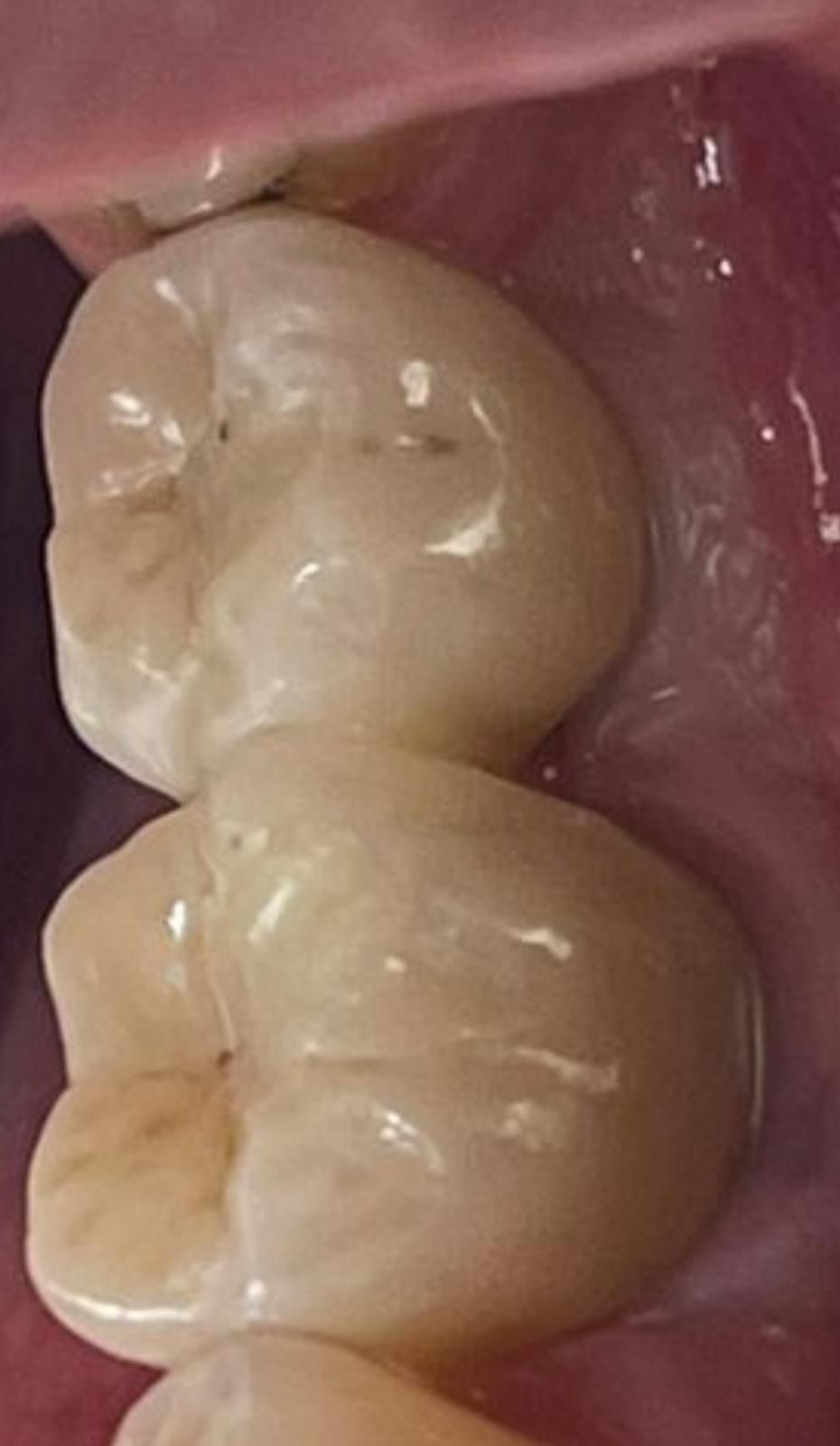 Primo piano di due molari lucidi all'interno della bocca, che mostra le superfici dei denti e le gengive.