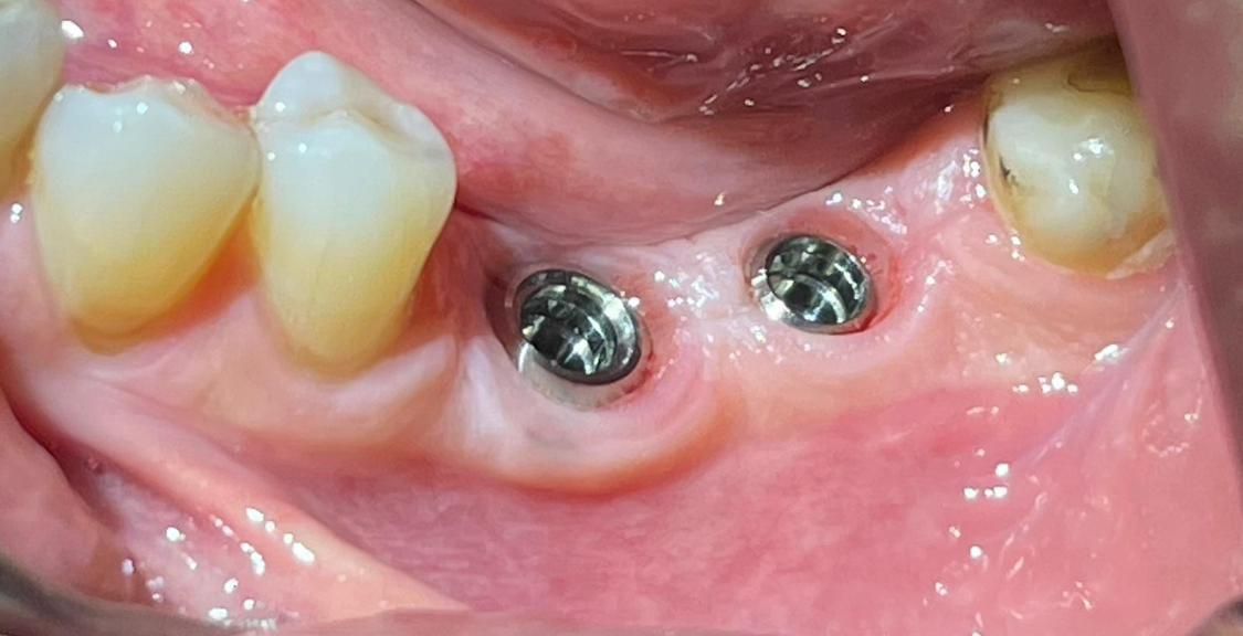Primo piano delle gengive inferiori con due impianti dentali in metallo lucido tra i denti