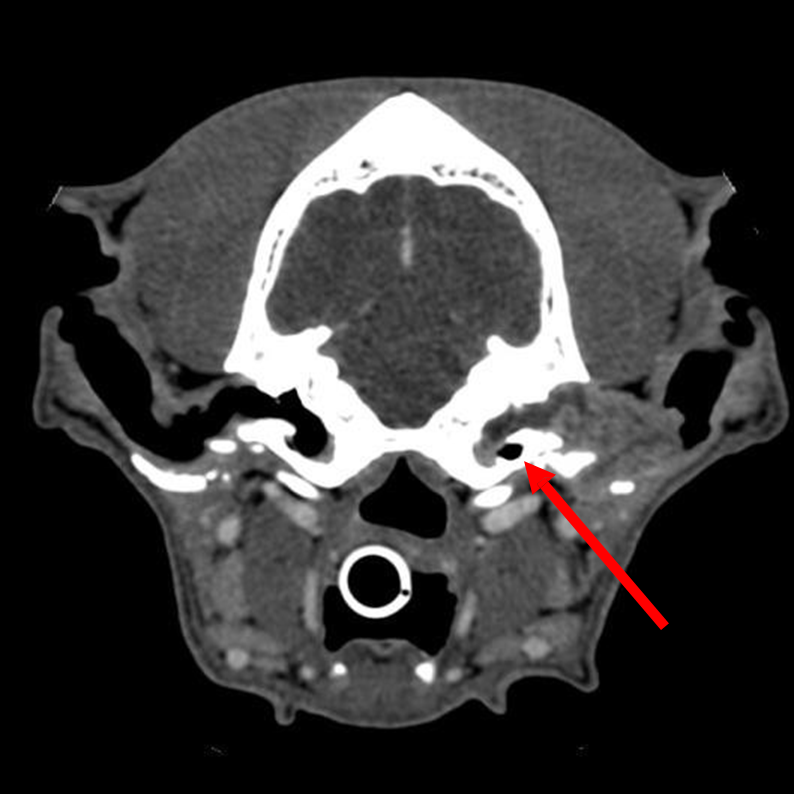 Chirurgie ablation du conduit auditif scanner