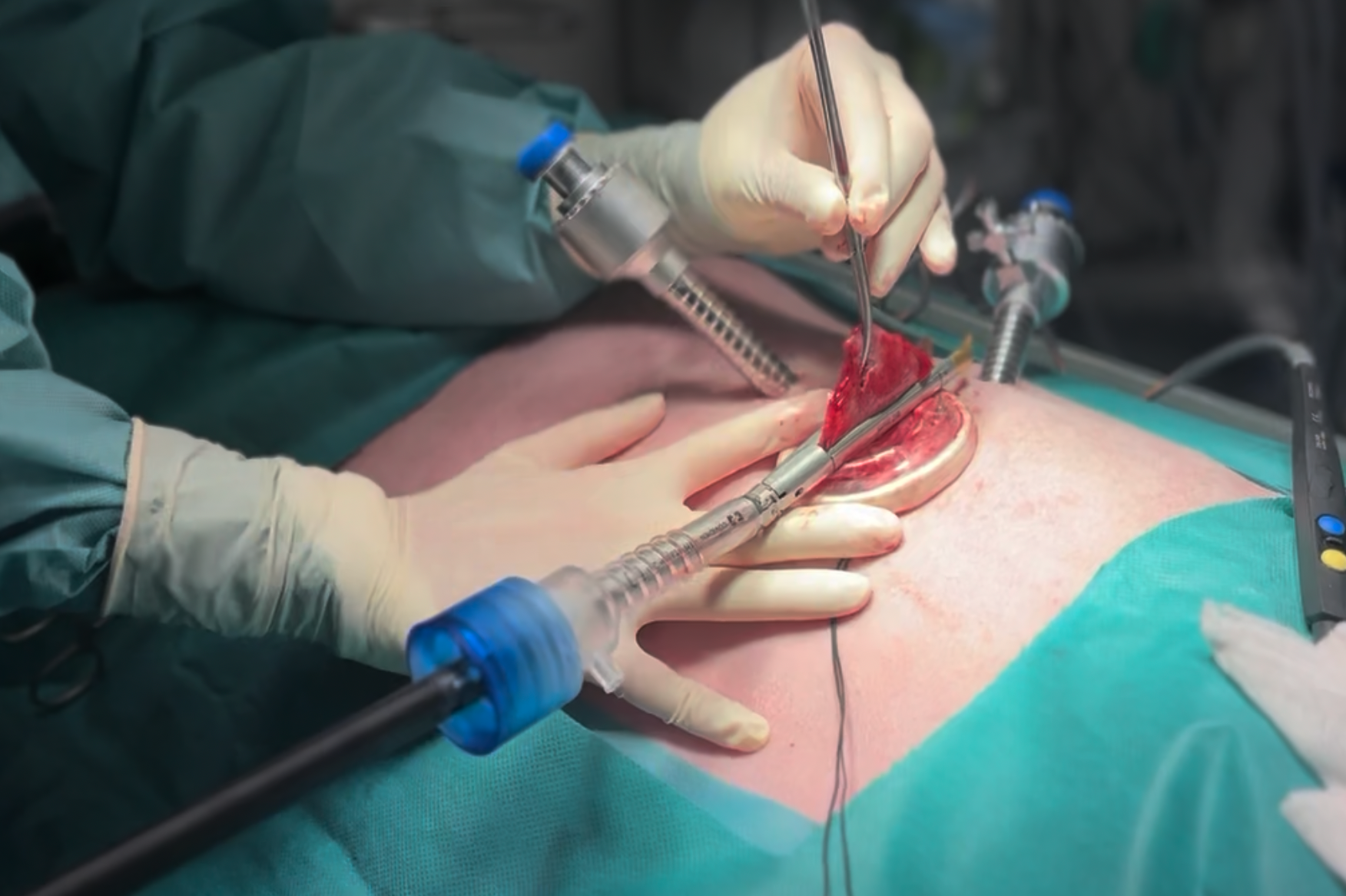 Des chirurgiens pratiquent une opération à abdomen ouvert sous une lumière chirurgicale intense.
